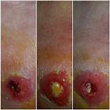 Colloidal Silver Wound Healing Images
