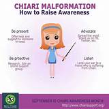 Chiari Malformation Surgery Recovery Pictures
