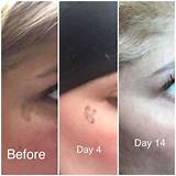 Laser Treatment To Remove Brown Spots Images