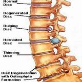 Home Treatment For Herniated Disc In Lower Back