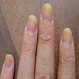 Nails Fungus Home Remedies Pictures