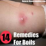 Pictures of Skin Boil Home Remedies