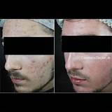 Images of Aggressive Acne Treatment