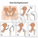 Images of Hip Replacement Recovery Timeline Elderly