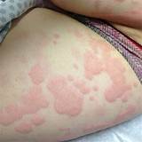 Chronic Hives Medication Pictures