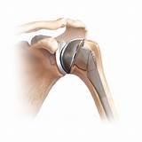 Images of Shoulder Joint Replacement Surgery Recovery