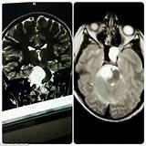 Photos of After Brain Tumour Surgery Side Effects