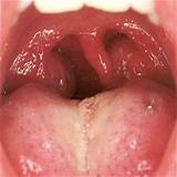 Angina Throat Treatment Images