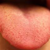 Photos of Pimple On Tongue Treatment