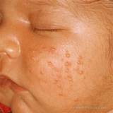 Pictures of Acne Treatment For Black Oily Skin