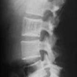 Images of Hemangioma Spine Treatment