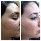 Pictures of What Is Micro Needling Treatment