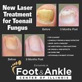 Foot Doctor For Nail Fungus Photos