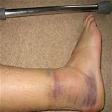 Photos of Swollen Ankle Sprain Treatment