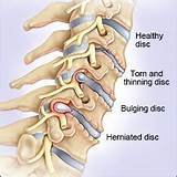 Images of Cervical Spine Disc Bulge Treatment