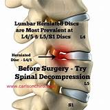 Photos of L5 S1 Herniated Disc Surgery Recovery Time
