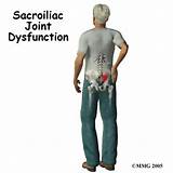 Pictures of Sacroiliac Joint Inflammation Treatment