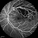 Images of Branch Retinal Vein Occlusion Mayo Clinic