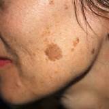 Images of Old Age Spot Removal