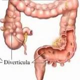 Photos of Diverticulitis Right Side Back Pain