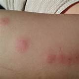 Treatment For Bed Bugs On Skin Images