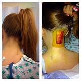 Pictures of Chiari Malformation Surgery Recovery