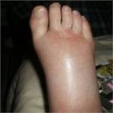 Pictures of Which Doctor To Consult For Swelling In Feet