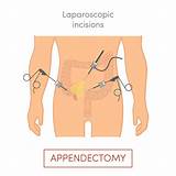 Pictures of Appendix Removal Recovery Time
