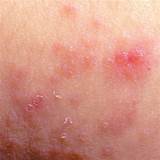 New Atopic Dermatitis Treatments Images