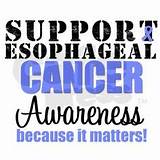 Mayo Clinic Esophageal Cancer