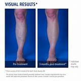 Photos of Chronic Venous Insufficiency Endovenous Laser Treatment