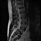 Images of Sciatica Workers Comp Settlement