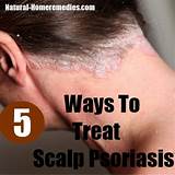Psoriasis On Your Scalp Treatment Pictures