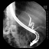 What Is A Ercp Medical Procedure Photos