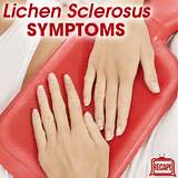 Images of Vulvar Lichen Sclerosus Home Remedies