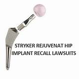 Stryker Hip Replacement Lawsuit Settlement Amounts Pictures