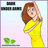 Fair Arms Home Remedies Pictures