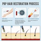 Pictures of Prp Hair Treatment Cost