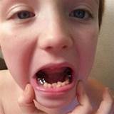 Silver Caps On Kids Teeth Pictures
