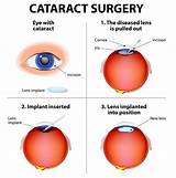 Cataract Medical Definition Images