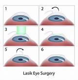 Pictures of Refractive Lasik Surgery