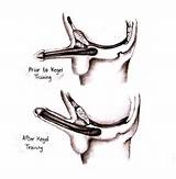 Pelvic Muscle Exercises Kegel Images