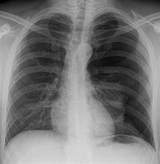 Pictures of Signs Of Gas In Chest