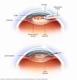 Pictures of Cataract Medical Definition
