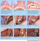 Images of Frenectomy Recovery