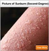 3rd Degree Sunburn Images