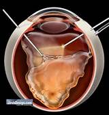 Pictures of Retinal Detachment Surgery Gas Bubble