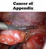 Appendix Cancer Treatment