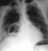 Images of Bacterial Pneumonia Recovery Time