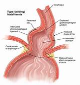 Images of Hiatal Hernia Doctor